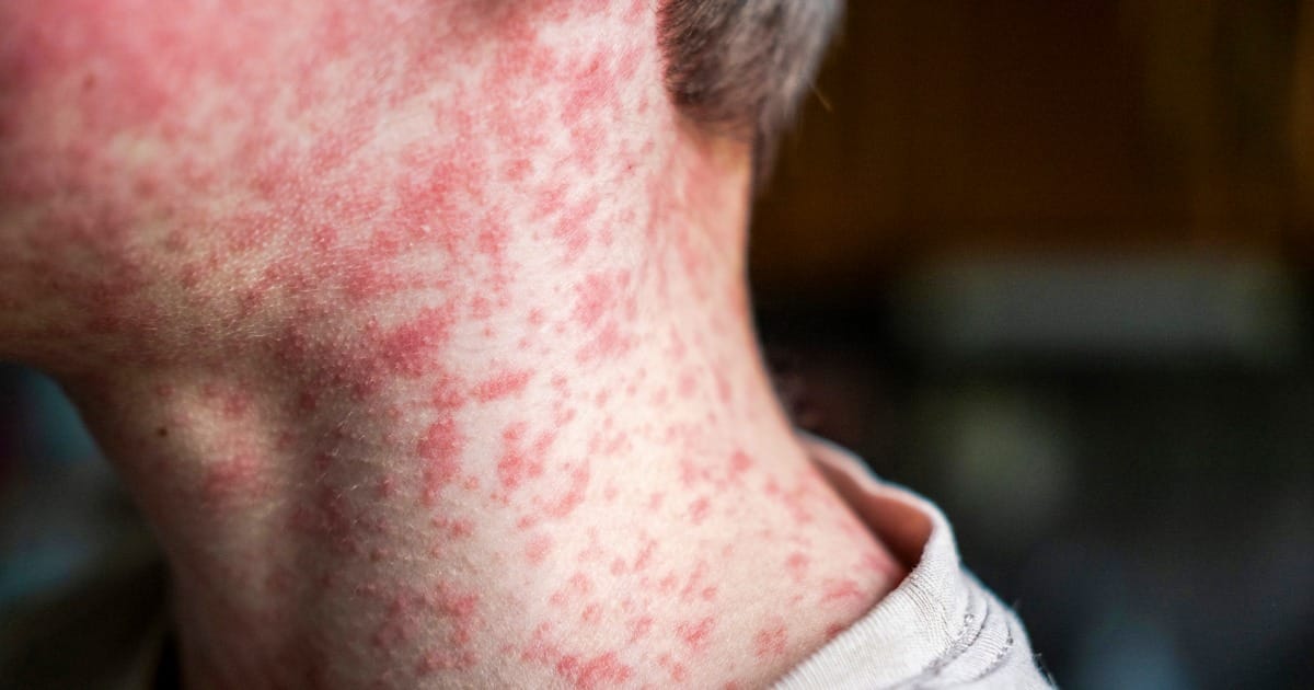Measles Outbreak Accelerates as Herd Immunity Nosedives