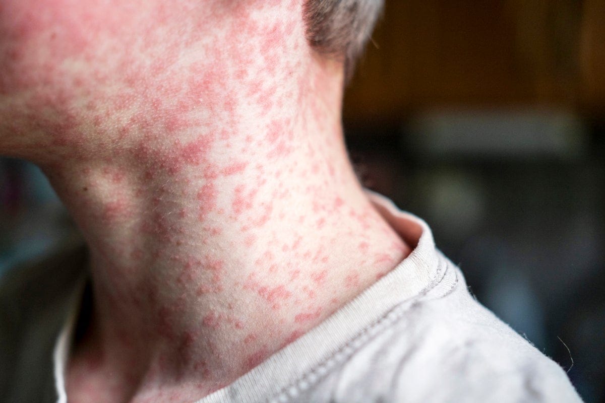 Measles Outbreak Accelerates as Herd Immunity Nosedives
